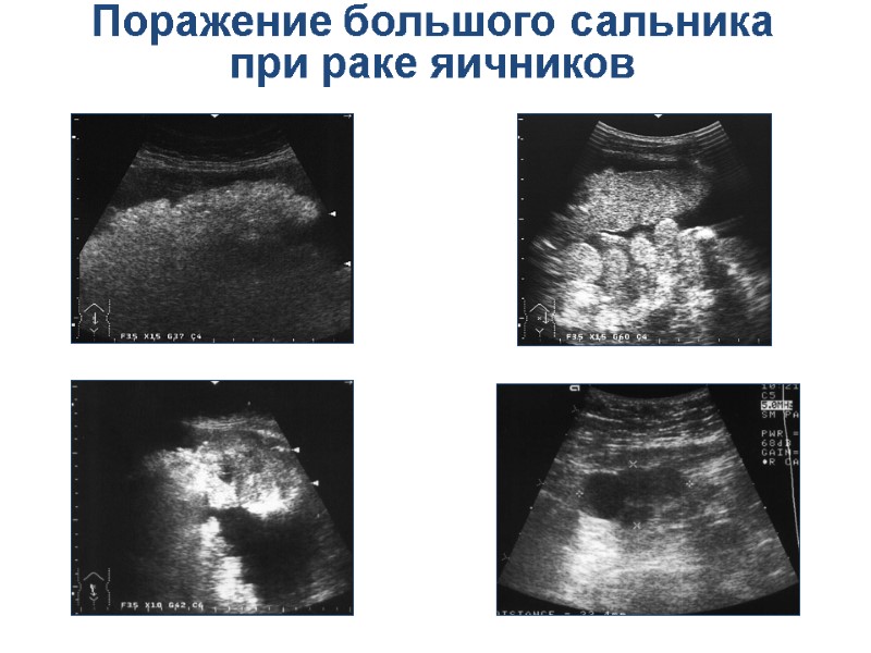 Поражение большого сальника при раке яичников